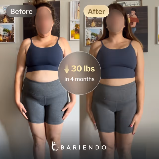 Before and after images of Iris who lost 30 pounds in 4 months after a Gastric Balloon procedure with Bariendo