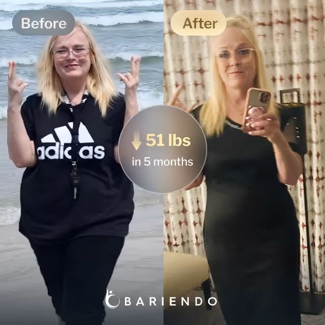 Before and after images of Jackie who lost 51 pounds in 5 months after a TORe procedure with Bariendo