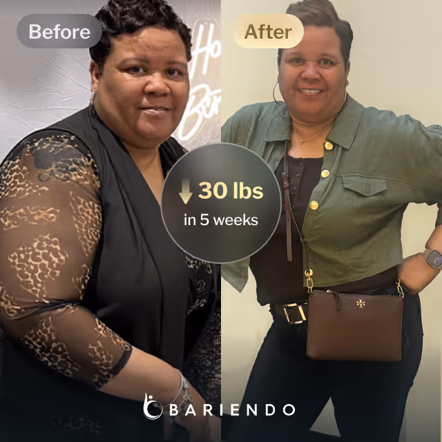 Before and after images of Gwendolyn who lost 30 pounds in 5 weeks after an ESG procedure