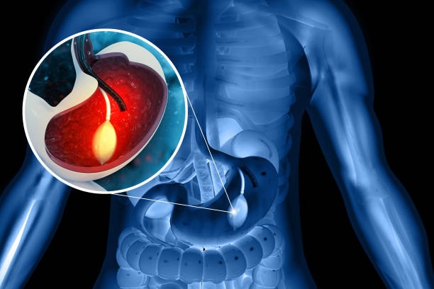 Gastric Balloon Inside a Stomach 3D Illustration