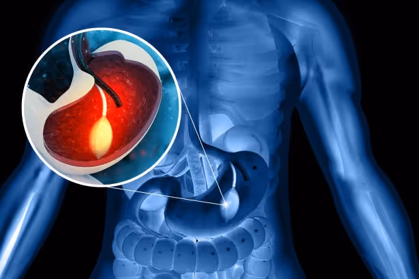 Gastric Balloon Inside a Stomach 3D Illustration