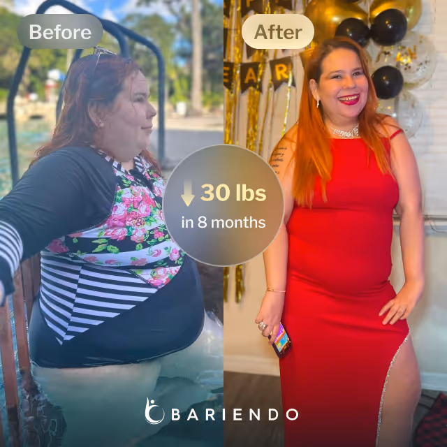 Before and after images of Isola who lost 30 pounds in 8 months after a Gastric Balloon procedure with Bariendo