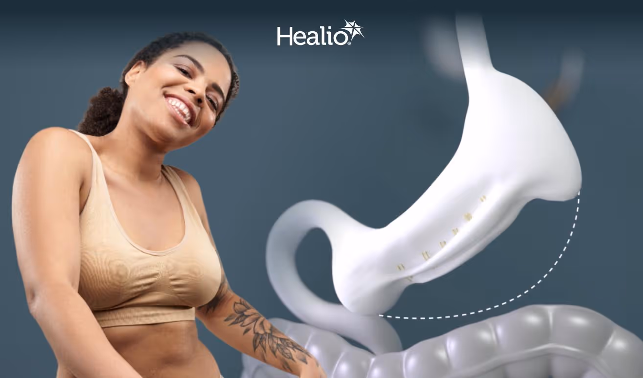 a smiling woman next to an illustrated model of an endoscopic sleeve gastroplasty (ESG) procedure