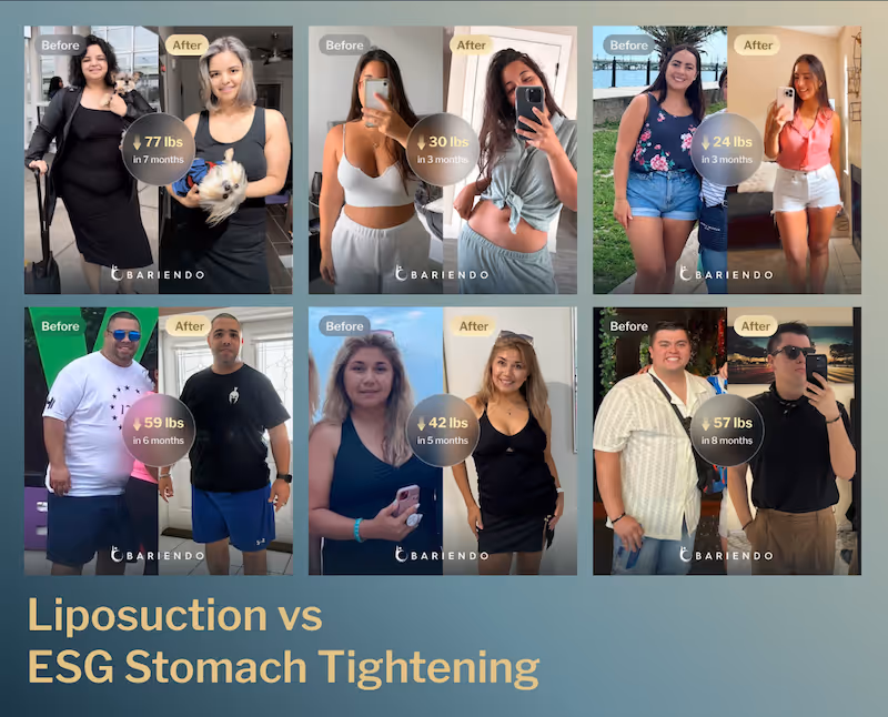 Before and after images of ESG stomach tightening patients
