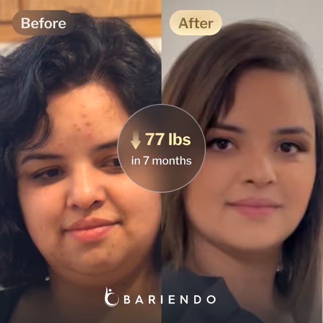 Before and after images of Nicole, a Bariendo ESG Stomach Tightening® patient who lose 77 pounds in 7 months