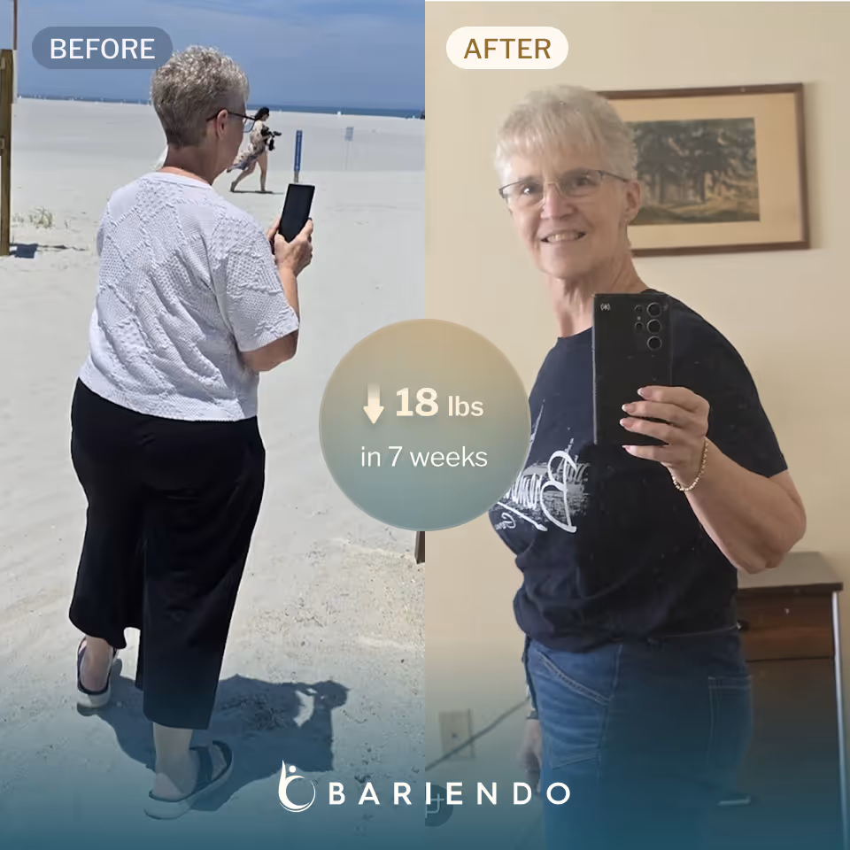 Diane lost 18 lbs with a TORe revision procedure with Bariendo