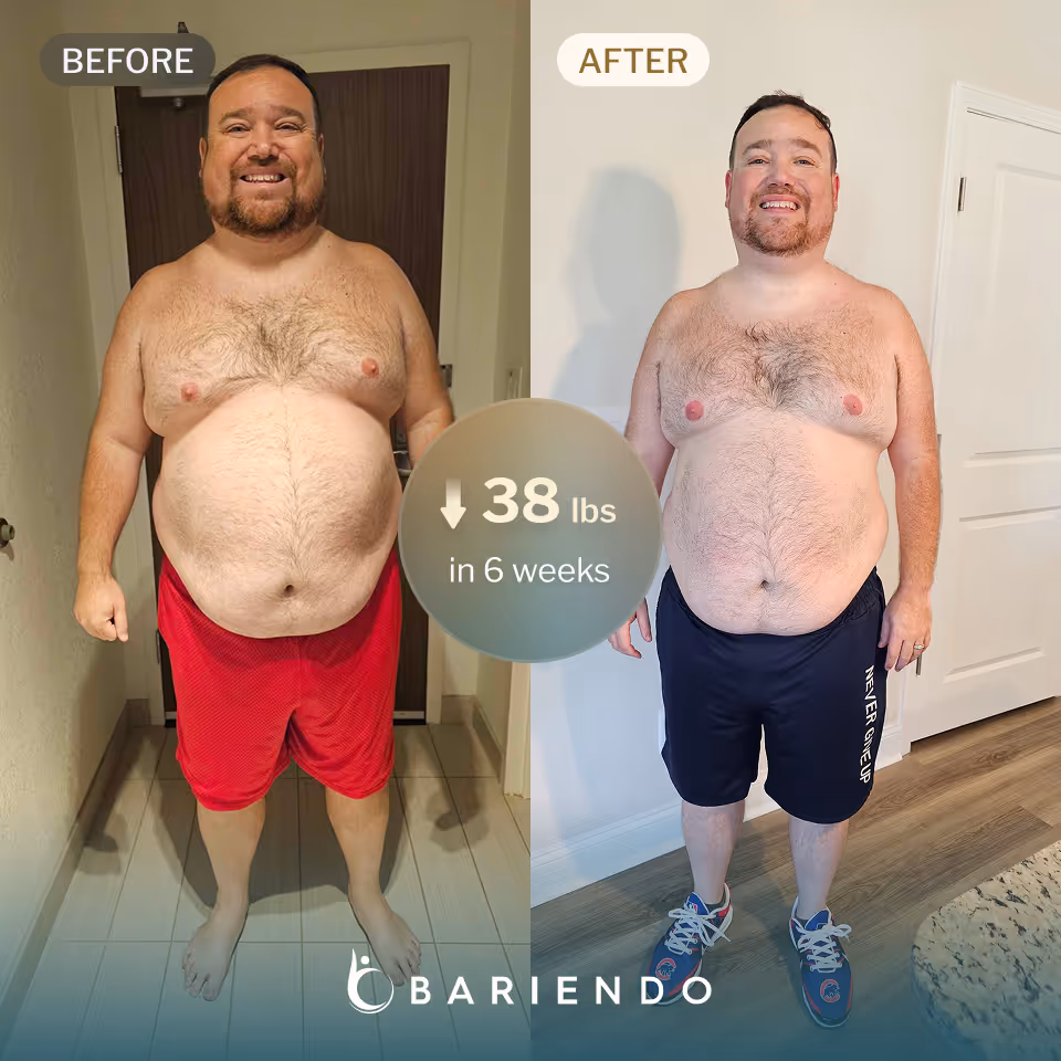 Clint has lost 38 lbs with Bariendo's revision of sleeve gastrectomy procedure