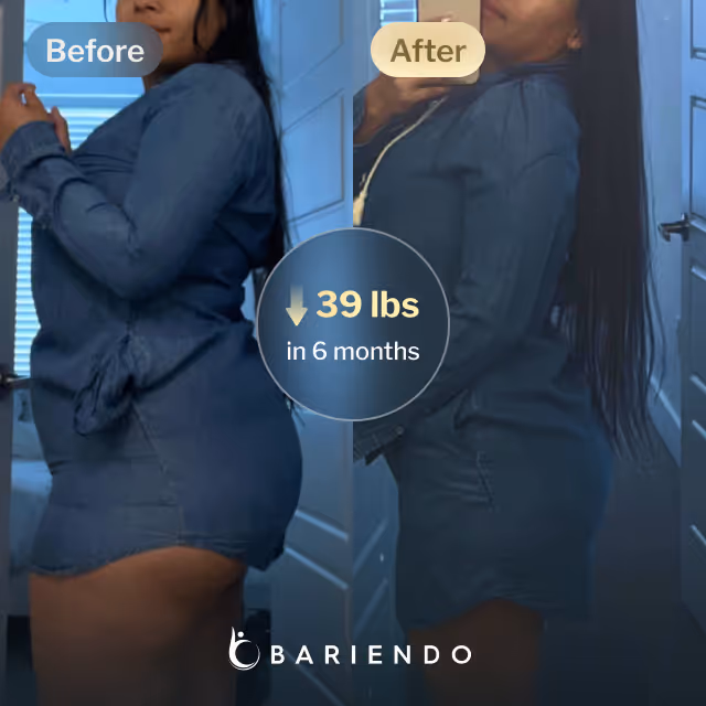 Before and after images of Daniela who lost 39 pounds in 6 months after a Gastric Balloon procedure with Bariendo