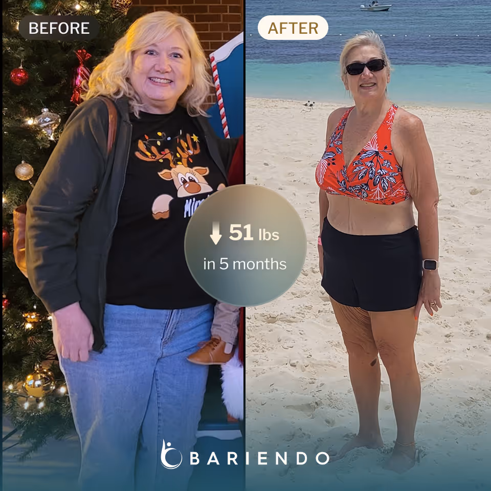 Caroline lost 51 pounds with an ESG from Bariendo